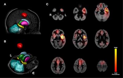 The Impacts of Tumor and Tumor Associated Epilepsy on Subcortical Brain Structures and Long Distance Connectivity in Patients With Low Grade Glioma